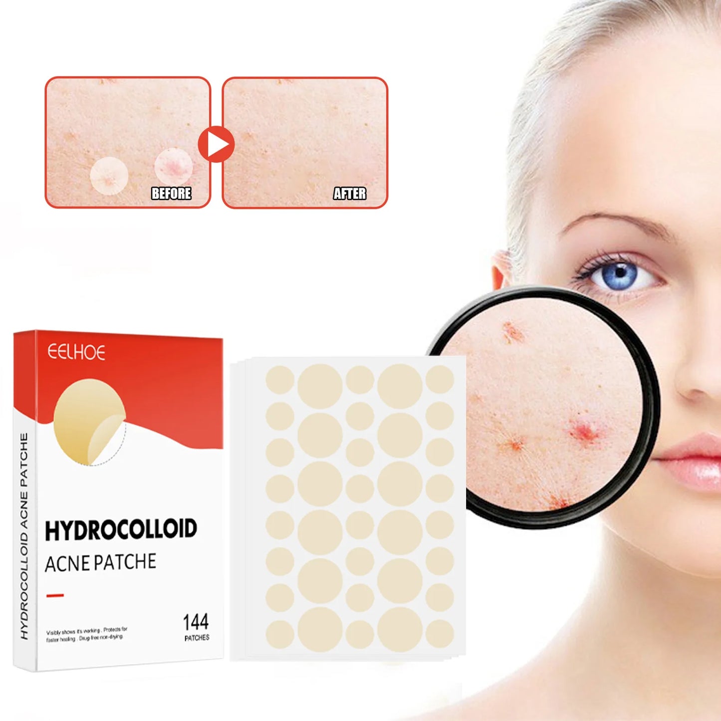 144pcs/set Face Skin Care Acne Pimple